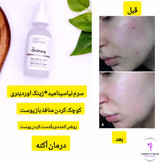 سرم ضد جوش نیاسینامید ۱۰٪ + زینک ۱٪ اوردینری، مناسب برای کنترل چربی و کاهش منافذ